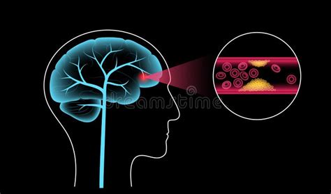 Brain Stroke Ishemic Stock Vector Illustration Of Infarct 223020437