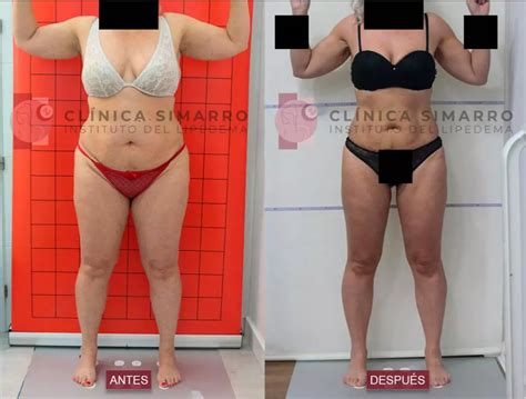 Lipedema Sin Cirugia 01 DrSimarro