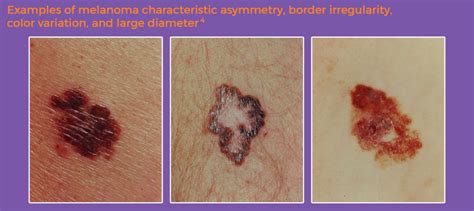 Pathophysiology Of Melanoma Activate Melanoma