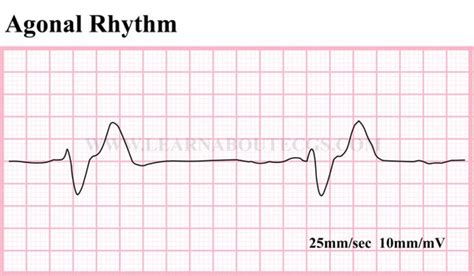 Items similar to Agonal Rhythm ECG Strip on Etsy