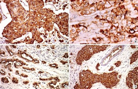 Muc1 Expression With Cytoplasmic Membranous And Apical Or Combinative