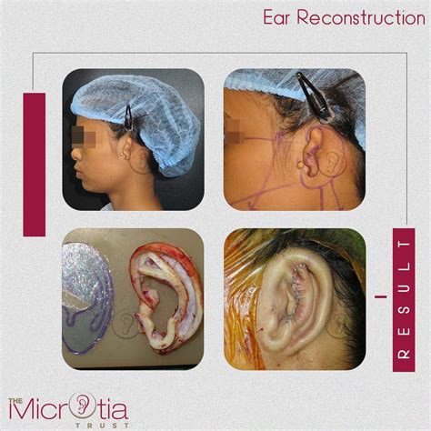 Popular Microtia Ear Surgery Cosmetic Procedures The Microtia Trust