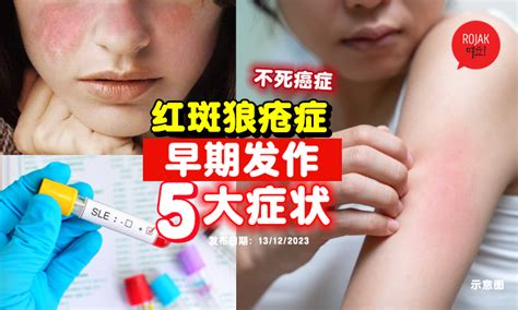 女性必看！红斑狼疮症被称为「不死癌症」⚡早期发作的「5大症状」！