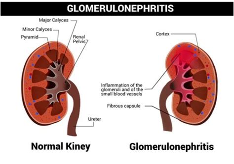 Glomerulonephritis - Symptoms, Causes, Types, Diagnosis & Treatment - Costamedic