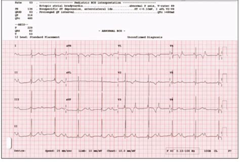 Figure 2 From Congenital Complete Heart Block Complicated By Atrial