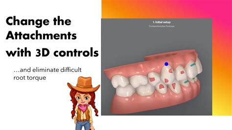 Invisalign ClinCheck Changing Attachments With 3D Controls YouTube