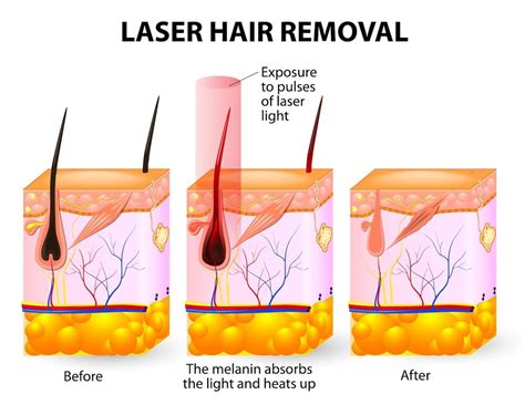 Laser Hair Removal Treatment in Mumbai and Delhi, India | Permanent Hair Removal Treatment