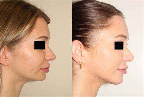 3 Chin Augmentation And Rhinoplasty Dr Denton