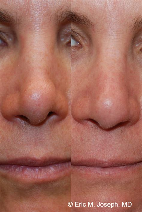 Eric M Joseph Md Permanent Non Surgical Rhinoplasty Nose Job