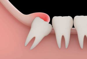 Surrounding Teeth Pain After Tooth Extraction Understanding Duration