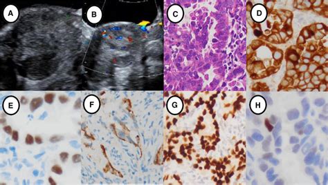 Ultrasonographic Features And Immunohistochemical Staining Of Primary