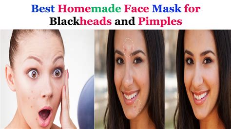 Best Homemade Face Mask For Blackheads And Pimples Youtube