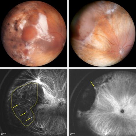 Peripheral Exudative Hemorrhagic Chorioretinopathy Polypoidal