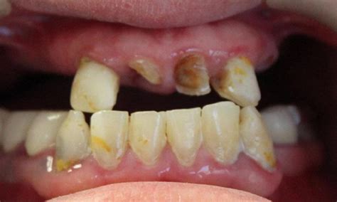 Hybrid Denture Before & After Photos | Vienna VA | Tysons Dentistry