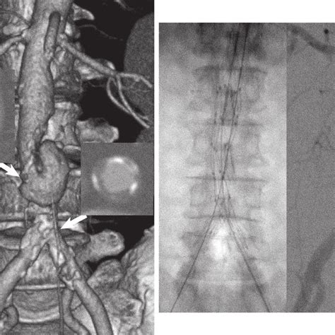 A Preoperative Three Dimensional Computed Tomography Imaging Showed