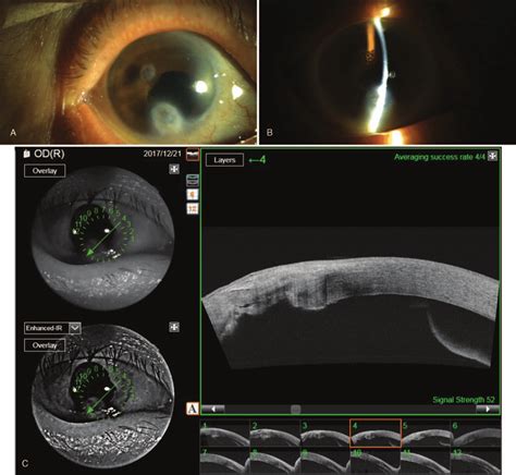 The Final Anterior Segment Image A B And The Oct Image C Reveal