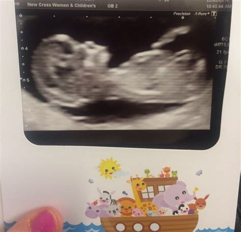 12 Week Scan Gender Guess I