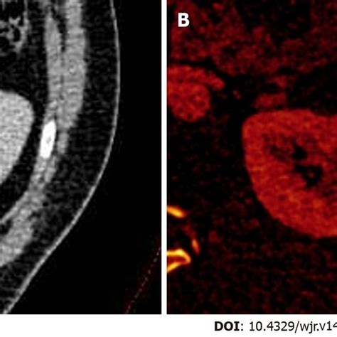 Dual Energy Computed Tomography Images A Contrast Enhanced Axial