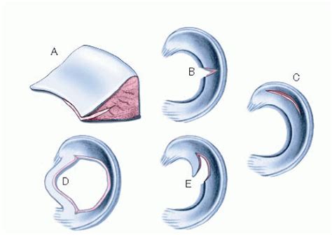 All Inside Arthroscopic Meniscal Repair Musculoskeletal Key