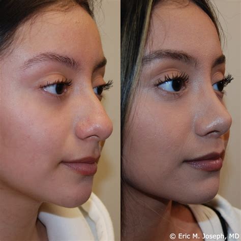 Eric M Joseph Md Rhinoplasty Before After Wide Tip Reduction