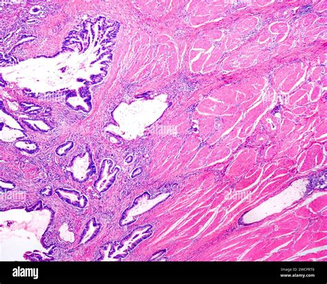 Adenocarcinoma Of The Colon Light Micrograph Stock Photo Alamy