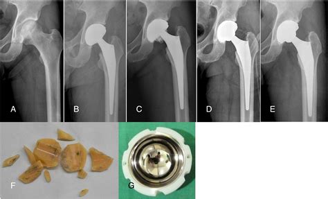 The Survival Analysis In Third Generation Ceramic On Ceramic Total Hip Arthroplasty The