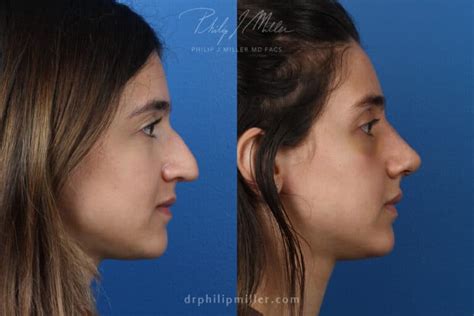 5 Rhinoplasty Trends In 2022 Philip Miller Md