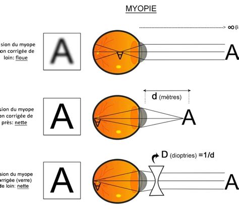 La Myopie Explications Et Conseils