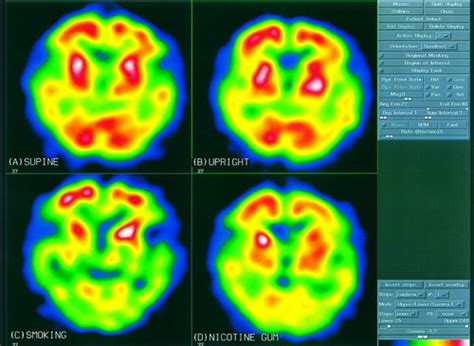 99mtc Hmpao Brain Spect Imaging In A Case Of Repeated Syncopal Episodes Associated With Smoking