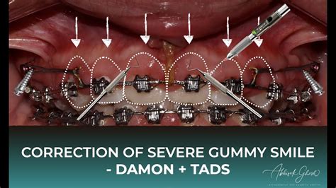 Lecture 9 Damon System And Tads For Correction Of Severe Gummy Smile