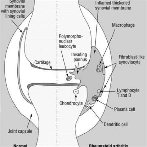 Advanced Rheumatoid Arthritis Of The Hands Metacarpophalangeal Download Scientific Diagram