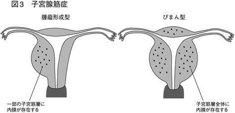 特集2 子宮筋腫・腺筋症・内膜症 よく相談して納得いく治療を 全日本民医連