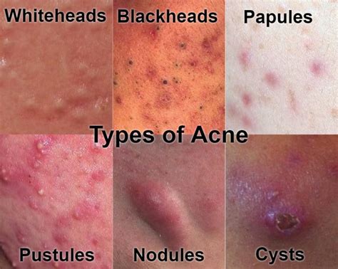 Types of Acne With Pictures: Mild, Moderate, Severe... - eHealthStar