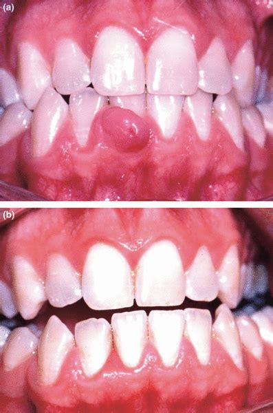 Gingival Enlargements And Localized Gingival Overgrowths Savage