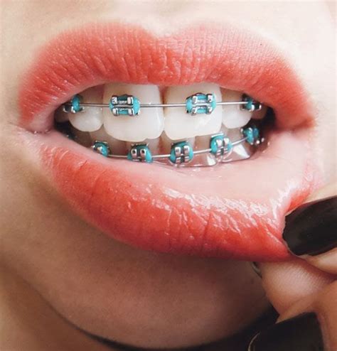 Braces: Metal Braces With Light Blue Bands