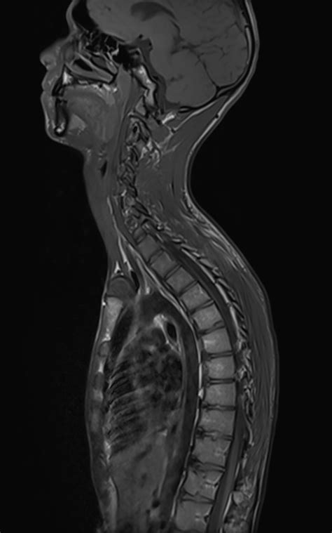 Scheuermann Disease Image Radiopaedia Org