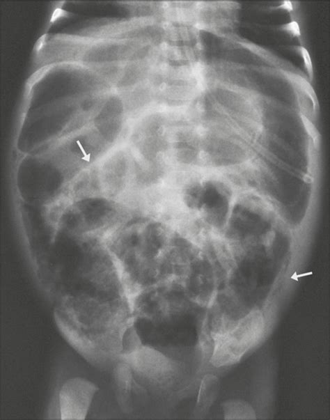 Necrotizing Enterocolitis X Ray