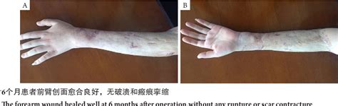 Figure 3 From Clinical Efficacy Of Vacuum Sealing Drainage And