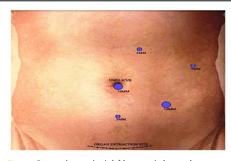 Comparison Between Hand Suture And Carter Thomason Needle Closure Of