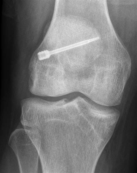 Anterior Cruciate Ligament Fixation Devices Expected Imaging