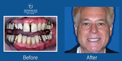 Dental Implants Marion IN Louisville KY 502 268 4840