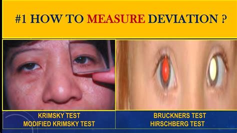 Measuring Squint Krimsky And Modified Krimskytest Bruckners Test