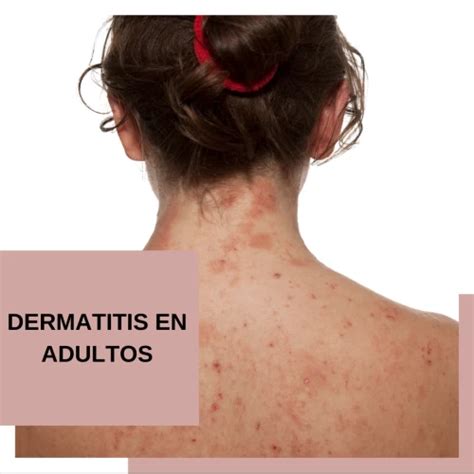 Dermatitis Atópica En Adultos Causas Síntomas Y Tratamiento