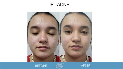 IPL Acne - Olam Med Spa