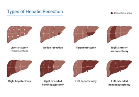 Types Of Hepatic Resection BioRender Science Templates