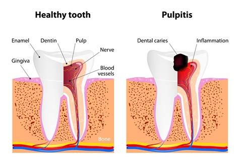 The Top Treatments For Pulpitis Sedation Dental Care At Raleigh Smile