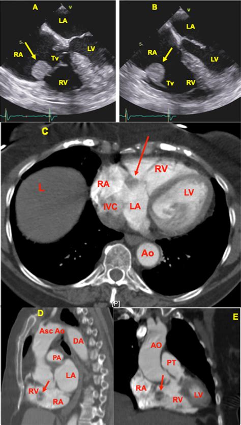 A Transesophageal Echocardiogram Midesophageal Four Chamber View