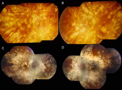 Birdshot Chorioretinopathy