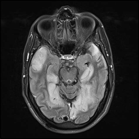 Mitochondrial encephalomyopathy, lactic acidosis, and stroke-like episodes (MELAS) | Image ...