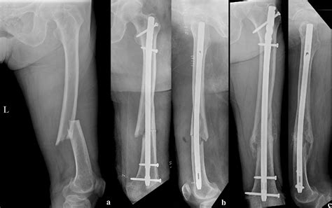 Surgical Outcomes Of Intramedullary Nailing For Diaphyseal Atypical Femur Fractures Is It Safe